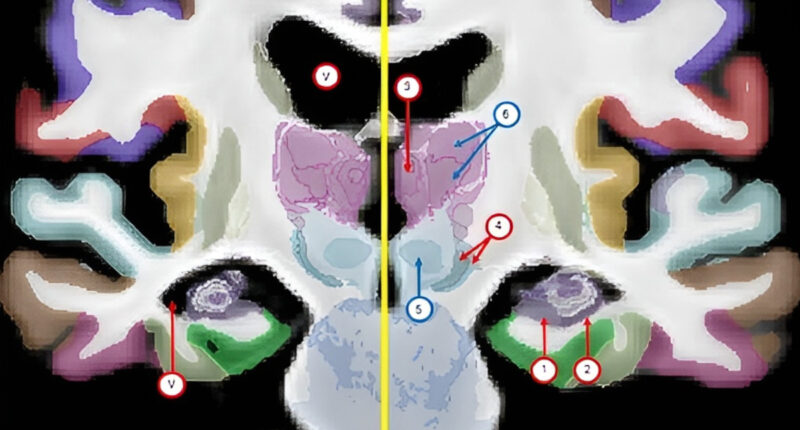 Alzheimer's v normal ageing comparison using NextBrain